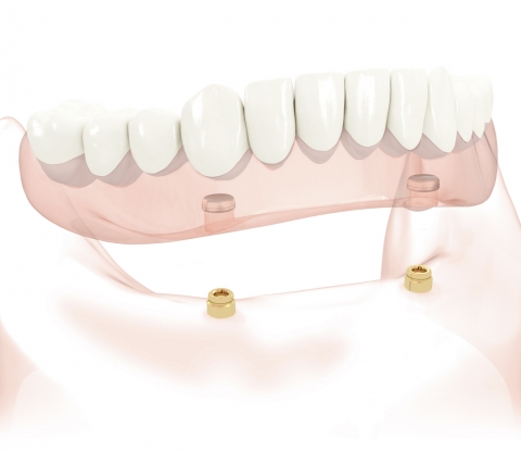 locator_abutment2